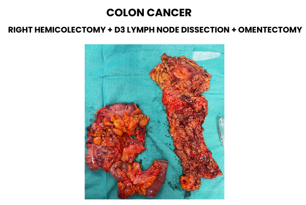 Colon Cancer Surgeon